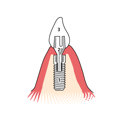 Aufbau eines Zahnimplantats Bild eines dreiteiligen Zahnimplantats