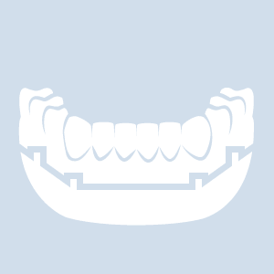 Fester Zahnersatz: Stegprothese Abbildung einer Stegprothese