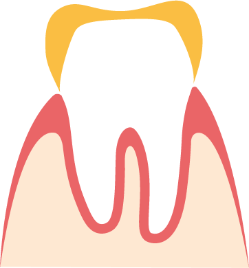Unverblendete Gold-Kronen Bild einer Gold-Krone