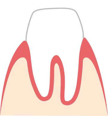 Zahnkronen mit Kunststoff-Verblendung sind weiß Bild einer Kunststoff-Krone