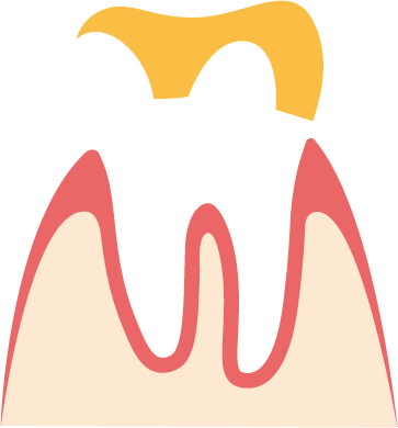 Teilkrone Veranschaulichung von Aufbau und Funktionsweise einer Teilkrone